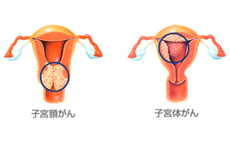 子宮体がん・子宮頸がん検診はコスモクリニックで